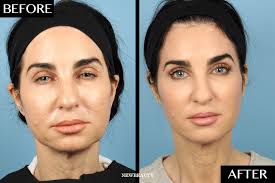 We did not find results for: The Nonsurgical Procedure That Gave This 52 Year Old Woman The Look Of A Full Facelift Newbeauty Face Threading Beauty Procedures Medical Skin Care