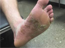 Image result for pompholyx soles of feet