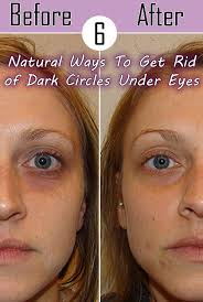 6 Natural Ways To Get Rid Of Dark Circles Under Eyes Dark Circles Under Eyes Dark Circles Undereye