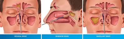 The polyps are removed from posterior to anterior direction. Balloon Sinuplasty Basics Treatment Cost Recovery And Side Effects