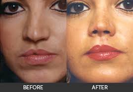 Cleft lip repair is surgery to fix a split (cleft) in the lip. Cleft Lip Surgery Beverly Hills Los Angeles West La Century City Hollywood