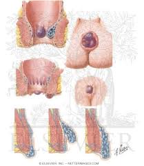 When the clot in a thrombosed hemorrhoid dissolves, you may have a bit of skin left over, which could get. Welcome To Netter Images