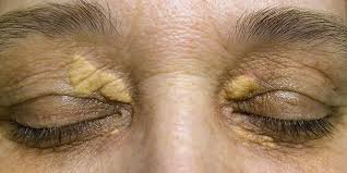 Xanthelasma Removal In Singapore | NeuGlow The Aesthetic Doctors