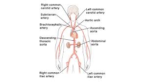 Aneurysm Disease The University Of Kansas Health System