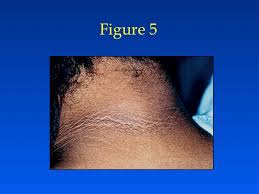 Endometriosis is defined as the presence of normal endometrial mucosa (glands and stroma) abnormally implanted in locations other than the uterine cavity (see the image below). Evaluation And Treatment Of Polycystic Ovary Syndrome Endotext Ncbi Bookshelf
