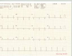 Listen to the teacher giving students advice for exams and do the exercises to practise and improve first, learn the main ideas and don't worry too much about the details. Coronary Artery Atherosclerosis Workup Approach Considerations Fractional Flow Reserve Lipid Studies