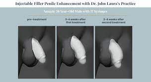 Penis Enlargement - Orange County | Penile girth enhancement