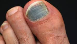 Ongles remark reconnaître un mélanome sousunguéal. Ongle De Pied Noir A Quoi Est Il Du Et Comment Le Soigner Pied Zen