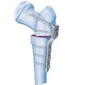 Pediatric LCP Plate System | Products | DePuy Synthes