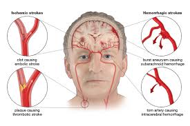 5 cause of death and a leading cause of disability in the united states. Stroke Facts Statistics Stroke Awareness Foundation