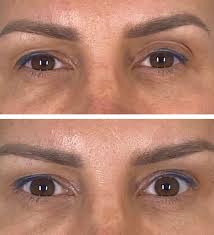 We did not find results for: Thread Lift Brisbane Gold Coast Non Surgical Face Lift