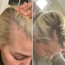 Skip or cancel any time. Postpartum Hair Loss Brittbayless