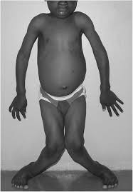 Image result for Rickets