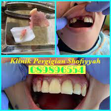 Maybe you would like to learn more about one of these? Gigi Palsu Segera Klinik Pergigian Shofiyyah Facebook