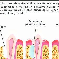 Pdf Barrier Membranes For Tissue Regeneration And Bone Augmentation Techniques In Dentistry