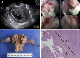 Here are 5 early warning signs of uterine cancer to approximately 60,000 new cases of the uterine cancer are diagnosed every year. Endometrial Adenocarcinoma Initially Mistaken As Urinary Incontinence Sciencedirect