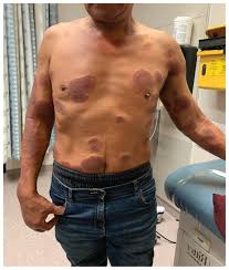 A type 1 leprosy reaction in a 50-year-old man | Homeopathic | Best Homeopathic Doctor in Pakistan | Dr Qaisar Ahmed MD, DHMS