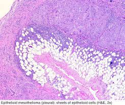 Desmoplastic mesothelioma is another type of mesothelioma that is related to the sarcomatoid type. Pathology Outlines Mesothelioma Peritoneum Epithelioid