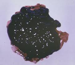 Image result for dark black stool human poop