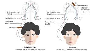 Bell's palsy and stroke are medical conditions that start in the brain. Bells Palsy And Tmj Dislocation Technology Medicine Telemedicine Charity The Virtual Doctors