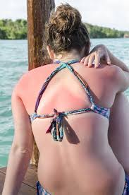How to stop hell's itch. Sunburn Itch Relief How To Stop Hell S Itch
