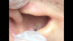 How to removal blackheads on face so relax | best pimple popping videos 2019 get the axe acne ebook today! Best Blackhead Popping And Removal Videos Of 2018