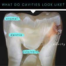The first signs of a dental cavity are often tooth pain or sensitivity to cold food or drinks. This Is What A Cavity Between Teeth Looks Like The Cavity Starts In The Harder Outer Shell The Enamel Once It Moves Through It Ent Cavities Dental Learning