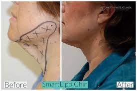 The staff at smart lipo cleveland are very knowledgable and understanding. Liposuction Vaser Smartlipo Pretty Faces Atlanta