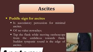 Image result for Shifting Dullness Test