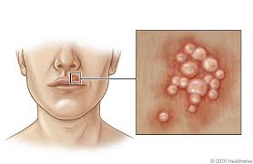 Image result for oral herpes symptoms roof of the mouth