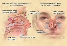 Image Result For Anatomy Of The Nose And Sinuses Sinus Polyps Polyp Sinusitis