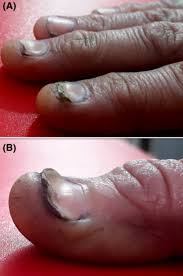 Image result for Koilonychia feet