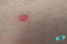 The condition affects people of any age, notes the american osteopathic college of dermatology, or aocd. Basal Cell Carcinoma Basalioma Bcc Online Dermatology