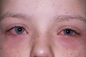 How do you know if you have eye allergy symptoms? Allergies Symptoms Nhs