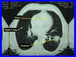 Many people with lung cancer don't notice any signs of the disease; Limited Stage Small Cell Lung Carcinoma Wikipedia