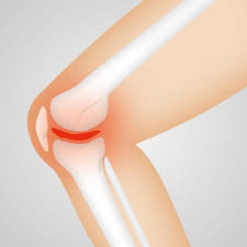 A meniscus tear is the most common cause of a true knee lock. Knee Swelling After Meniscus Surgery