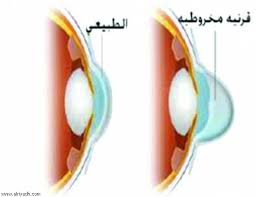 كيف يتم علاج القرنية المخروطية Keratoconus حجز موعيد جميع جراحات العيون 051048002