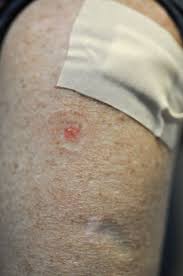 In the united states, it's estimated that doctors diagnose over 100,000 new skin cancer cases each year. Surviving With Skin Cancer A Way Of Life Article The United States Army