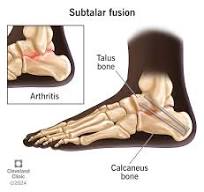 Subtalar Fusion Surgery: Procedure & Recovery