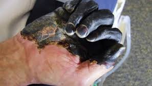 Pest utilities are those that are supplied when you download pest. Slik Dreper Svartedaudens Bakterie Fortsatt