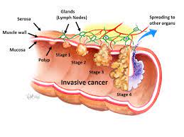Signs and symptoms of colon cancer are often not specific, which means they may be mistaken for a number of different conditions. Bowel Cancer Colorectal Surgeons Sydney