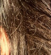 How To Get Rid Of Head Lice And Nits With Vinegar And Conditioner Head Lice Nits Lice Nits Head Lice Remedy