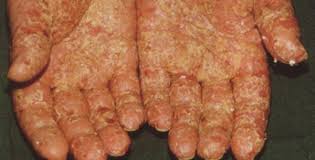 Image result for dermatitis contacta allergica