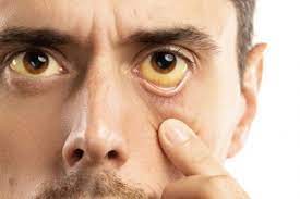 Gelbe Augen Ursachen Behandlung Vorbeugung Gesundpedia De