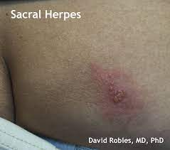 The severity and number of outbreaks tend to lessen over time. David Robles Md Phd Dermatologist Sacral Herpes Genital Herpes Hsv 2 Presenting On The Buttock
