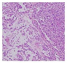 How to use malignant in a sentence. Malignant Chondroid Syringoma Wikipedia