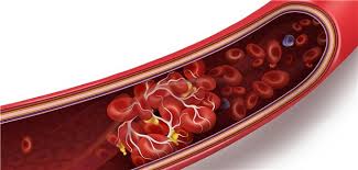 Une toulousaine est décédée des suites d'une thrombose survenue 14 jours après sa première injection au vaccin. P86hoeaxwx Gim