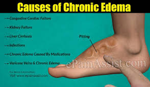 Pin On Edema