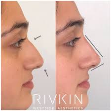 Before And After 5 Minute Nose Job Beautiful Natural Results To Hide The Bump On The Bridge Of Her Nose And Li Nose Job Nose Fillers Rhinoplasty Nose Jobs