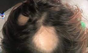 4.3 out of 5 stars 967. Hundreds Of Women Join Class Action Lawsuit Claiming Wen Hair Care Product Caused Hair Loss Wgn Tv
